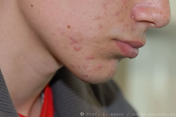 Acne papulopustulosa. Entzündliche Knötchen, teilweise mit zentraler Pusteln neben Komedonen.