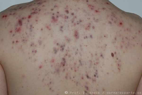 Acne conglobata. Am Rücken dichte Aussaat stärker entzündlicher Knoten neben Komedonen